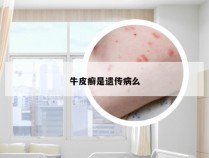 牛皮癣是遗传病么