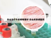 白山治疗牛皮癣哪里好 白山皮肤病医院