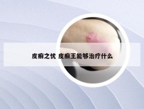 皮癣之忧 皮癣王能够治疗什么