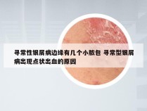 寻常性银屑病边缘有几个小脓包 寻常型银屑病出现点状出血的原因