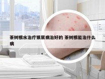 茶树根水治疗银屑病治好的 茶树根能治什么病