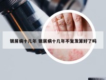 银屑病十几年 银屑病十几年不复发算好了吗