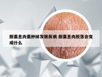 胆囊息肉囊肿掉发银屑病 胆囊息肉脱落会变成什么