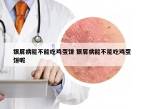 银屑病能不能吃鸡蛋饼 银屑病能不能吃鸡蛋饼呢