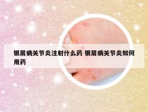 银屑病关节炎注射什么药 银屑病关节炎如何用药