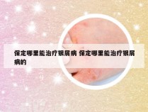 保定哪里能治疗银屑病 保定哪里能治疗银屑病的