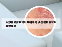 头部有银屑病可以戴帽子吗 头部银屑病可以戴假发吗