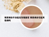 银屑病会不会起在生殖器官 银屑病会引起其他病吗
