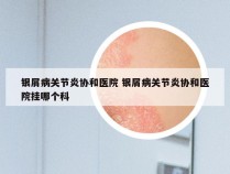 银屑病关节炎协和医院 银屑病关节炎协和医院挂哪个科