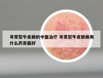 寻常型牛皮癣的中医治疗 寻常型牛皮肤癣用什么药膏最好