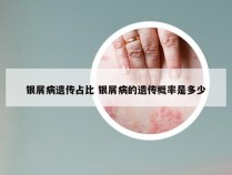 银屑病遗传占比 银屑病的遗传概率是多少