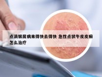 点滴银屑病来得快去得快 急性点状牛皮皮癣怎么治疗