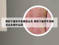 男的下面长牛皮癣怎么办 男的下面长牛皮癣怎么办用什么药