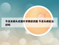 牛皮皮癣头皮图片早期症状图 牛皮头癣能治好吗