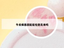 牛皮癣基因能能检查出来吗