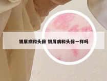 银屑病和头藓 银屑病和头藓一样吗