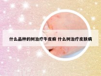 什么品种的树治疗牛皮癣 什么树治疗皮肤病