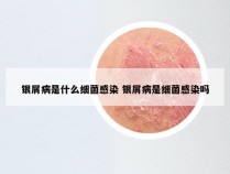 银屑病是什么细菌感染 银屑病是细菌感染吗