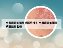 全国最好的银屑病医院排名 全国最好的银屑病医院排名榜