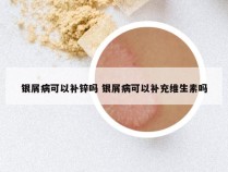 银屑病可以补锌吗 银屑病可以补充维生素吗