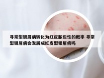寻常型银屑病转化为红皮脓包性的概率 寻常型银屑病会发展成红皮型银屑病吗