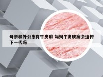 母亲和外公患有牛皮癣 妈妈牛皮肤癣会遗传下一代吗