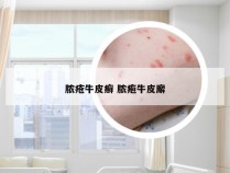 脓疮牛皮癣 脓疱牛皮廨