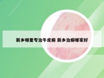 新乡哪里专治牛皮癣 新乡治癣哪家好