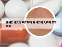 脉络舒通丸治牛皮癣吗 脉络舒通丸的用法与用量