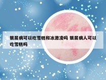 银屑病可以吃雪糕和冰激凌吗 银屑病人可以吃雪糕吗