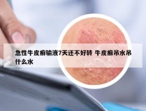 急性牛皮癣输液7天还不好转 牛皮癣吊水吊什么水