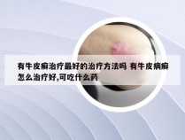 有牛皮癣治疗最好的治疗方法吗 有牛皮病癣怎么治疗好,可吃什么药