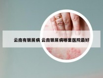 云南有银屑病 云南银屑病哪里医院最好