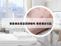 银屑病会感染到颈椎吗 银屑病会引起