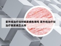 紫外线治疗仪对银屑病有用吗 紫外线治疗仪治疗银屑病怎么样