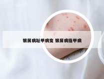 银屑病趾甲病变 银屑病指甲病
