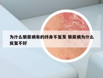 为什么银屑病有的终身不复发 银屑病为什么反复不好