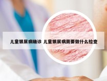 儿童银屑病确诊 儿童银屑病需要做什么检查