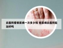 去医院看银屑病一次多少钱 银屑病去医院能治好吗