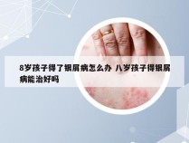 8岁孩子得了银屑病怎么办 八岁孩子得银屑病能治好吗