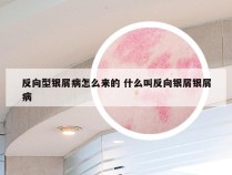 反向型银屑病怎么来的 什么叫反向银屑银屑病
