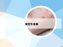 安慰牛皮癣