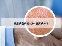 银屑病怎样消红肿 银屑病肿了