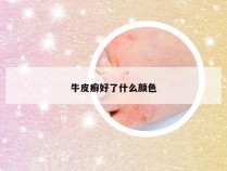 牛皮癣好了什么颜色