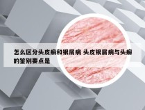 怎么区分头皮癣和银屑病 头皮银屑病与头癣的鉴别要点是