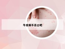 牛皮癣不忌口吧