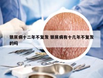 银屑病十二年不复发 银屑病有十几年不复发的吗