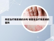 附近治疗银屑病的诊所 哪里有治疗银屑病的医院