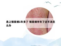 患上银屑病1年多了 银屑病半年了还不消怎么办