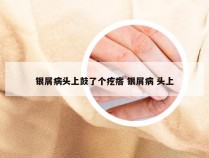 银屑病头上鼓了个疙瘩 银屑病 头上